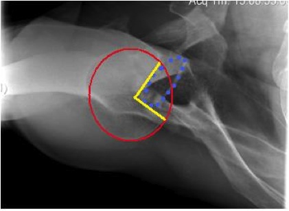 Posterior Shoulder Dislocaton Head Defect Quantification